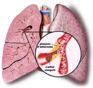 L'Embolie Pulmonaire