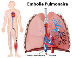 Traitement Naturel Contre Embolie Pulmonaire