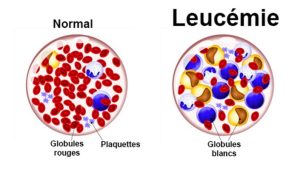 La Leucémie