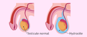 Testiculaire Hydrocèle Vaginale