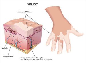 Vitiligo