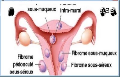 Phytothérapie Fibrome Traitement naturel pour Fibrome utérin