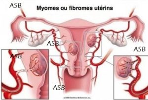 Utérus polymyomateux