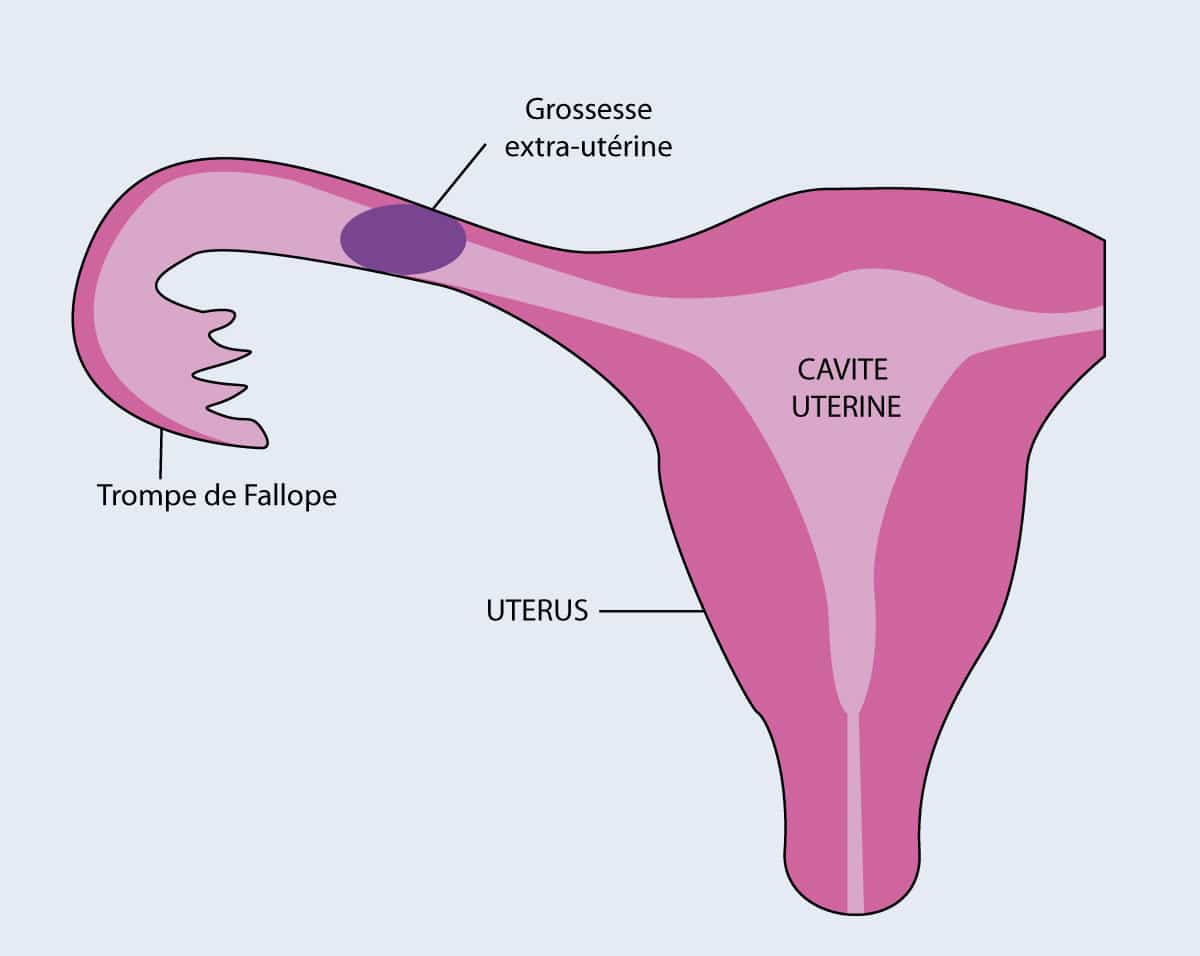 grossesse extra utérine symptomes