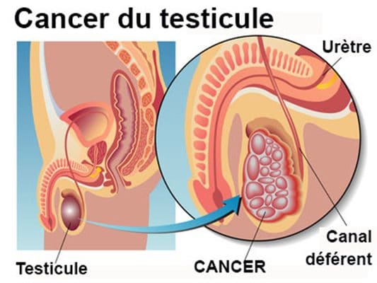 Cancer des testicules traitement naturel